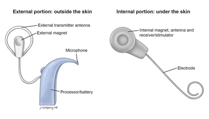 Cochlear Implants: Surgery - Risks - NYEE
